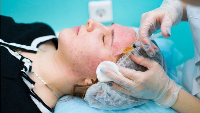 Facial Vampir Bikin Awet Muda?