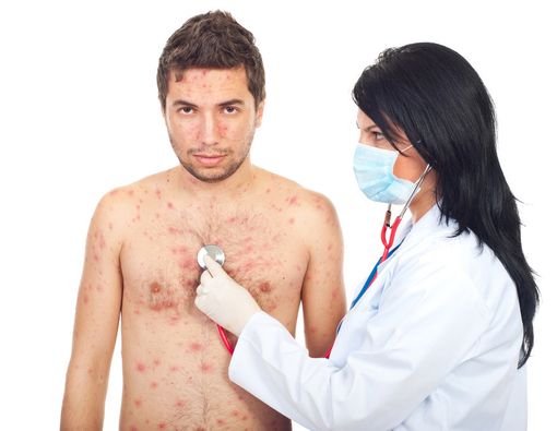 Bisakah Cacar Air Terjadi Lebih dari Sekali?