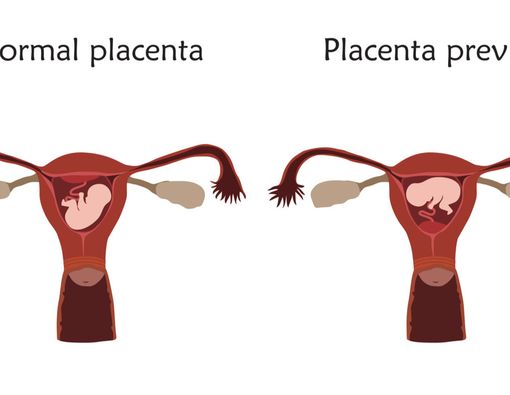 Plasenta Previa Pada Ibu Hamil, Apa Itu?