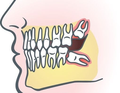 Gigi Geraham Bungsu Tidak Tumbuh? Waspadai Komplikasi Ini
