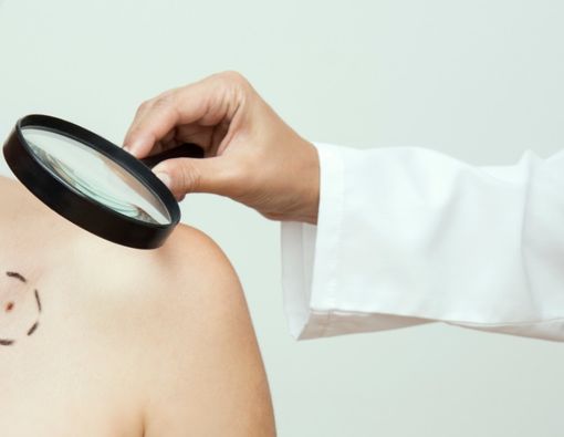 Perbedaan Kanker Kulit Melanoma dan Karsinoma