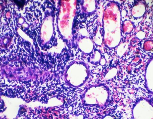 Mengenal Polip Serviks, Tumor Jinak yang Tumbuh di Leher Rahim