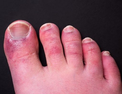 Gejala Infeksi Corona Mirip Cantengan? Waspada COVID Toes