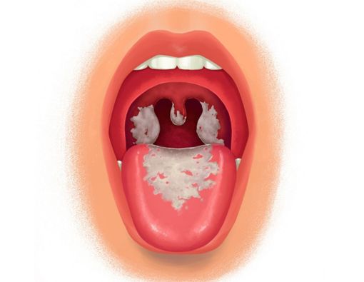 4 Alasan Mengapa Penyakit Difteri Tak Boleh Disepelekan