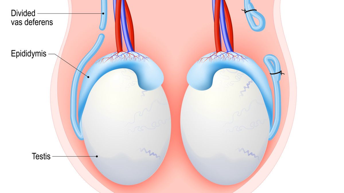 Benarkah Vasektomi Bisa Turunkan Libido Pria?