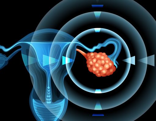Gejala Kanker Ovarium yang Harus Diwaspadai Wanita