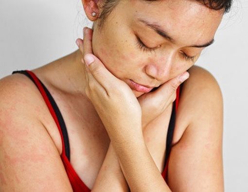 Tanda dan Gejala Alergi yang Sering Salah Dipersepsikan