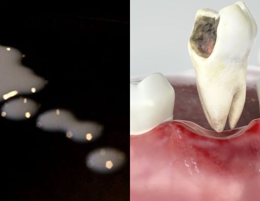 Benarkah Air Mani Bisa Mengatasi Gigi Berlubang?