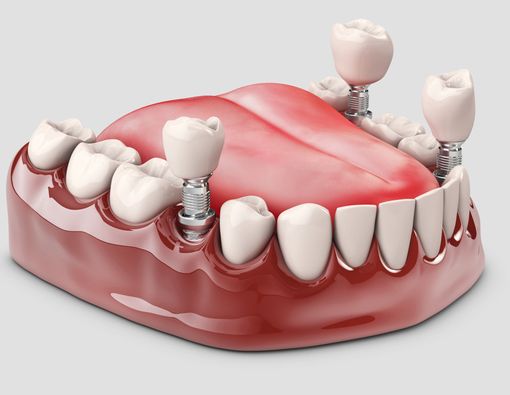 Gigi Palsu atau Implan Gigi, Mana yang Lebih Baik?