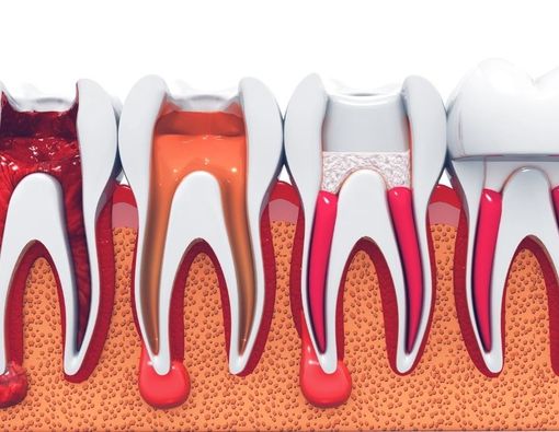 Persiapan Sebelum Jalani Perawatan Saluran Akar Gigi