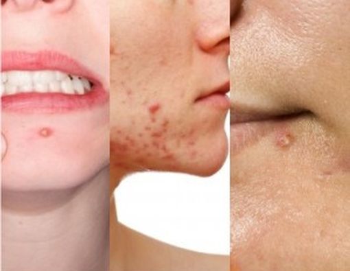 Kenali Jenis-Jenis Jerawat pada Kulit