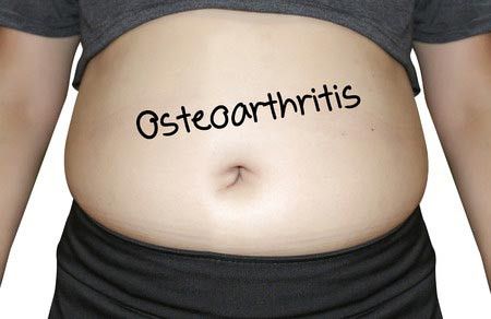 Obesitas Dapat Memicu Radang Sendi