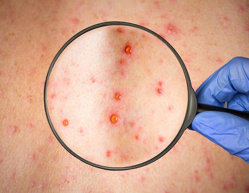 Vaksin MR, Cara Terbaik Mencegah Campak dan Rubela