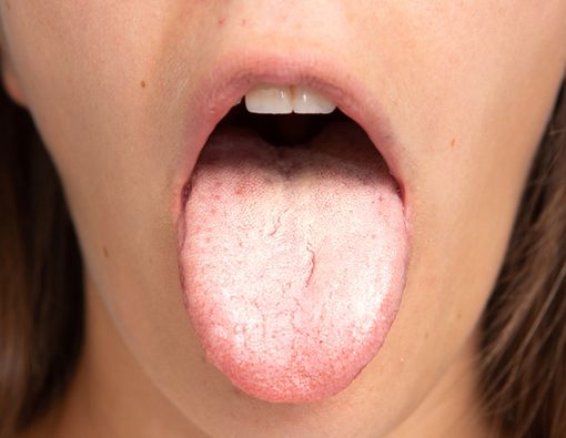 Kenali Coated Tongue, Penyebab Bau Mulut