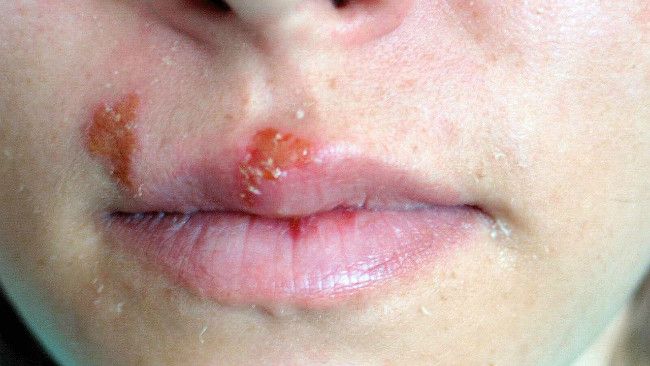 Herpes Labialis, Apa Pemicu dan Bagaimana Penularannya?