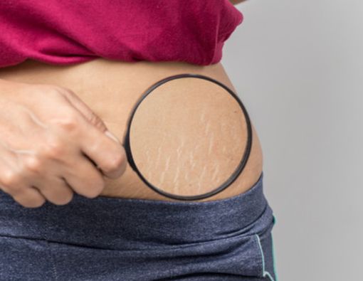 Tips Menghilangkan Stretch Mark Secara Alami