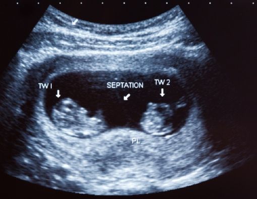 Mengenal Ragam Jenis-Jenis Hamil Kembar Siam