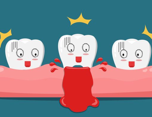 Benarkah Gusi Berdarah Bisa Berujung pada Kanker?