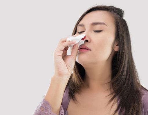 Mimisan (Epistaksis)