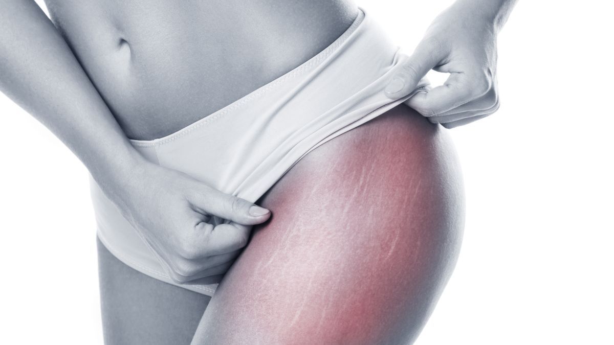 4 Gejala Stretch Mark di Kulit