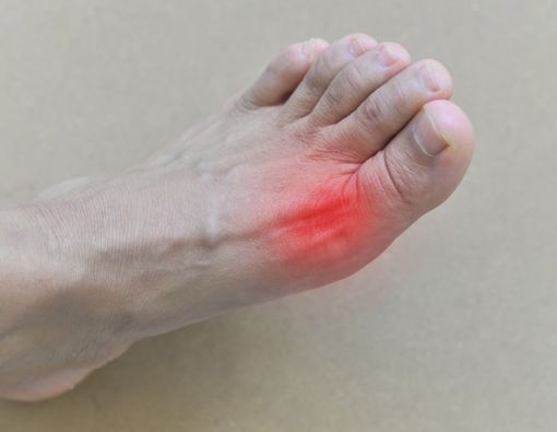 Mengenal Tophi, Komplikasi Asam Urat Karena Tidak Diobati