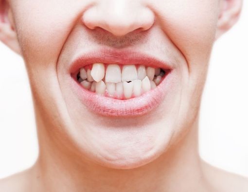 Ketahui Penyebab Gigi Gingsul, Apakah Berbahaya?