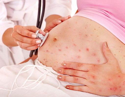 Benarkah Cacar Air Saat Hamil Picu Gangguan Pada Rahim?