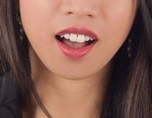 Apakah Bernapas Melalui Mulut Dapat Mempengaruhi Gigi?