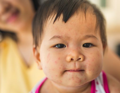 Kenali Perbedaan Campak dan Campak Jerman