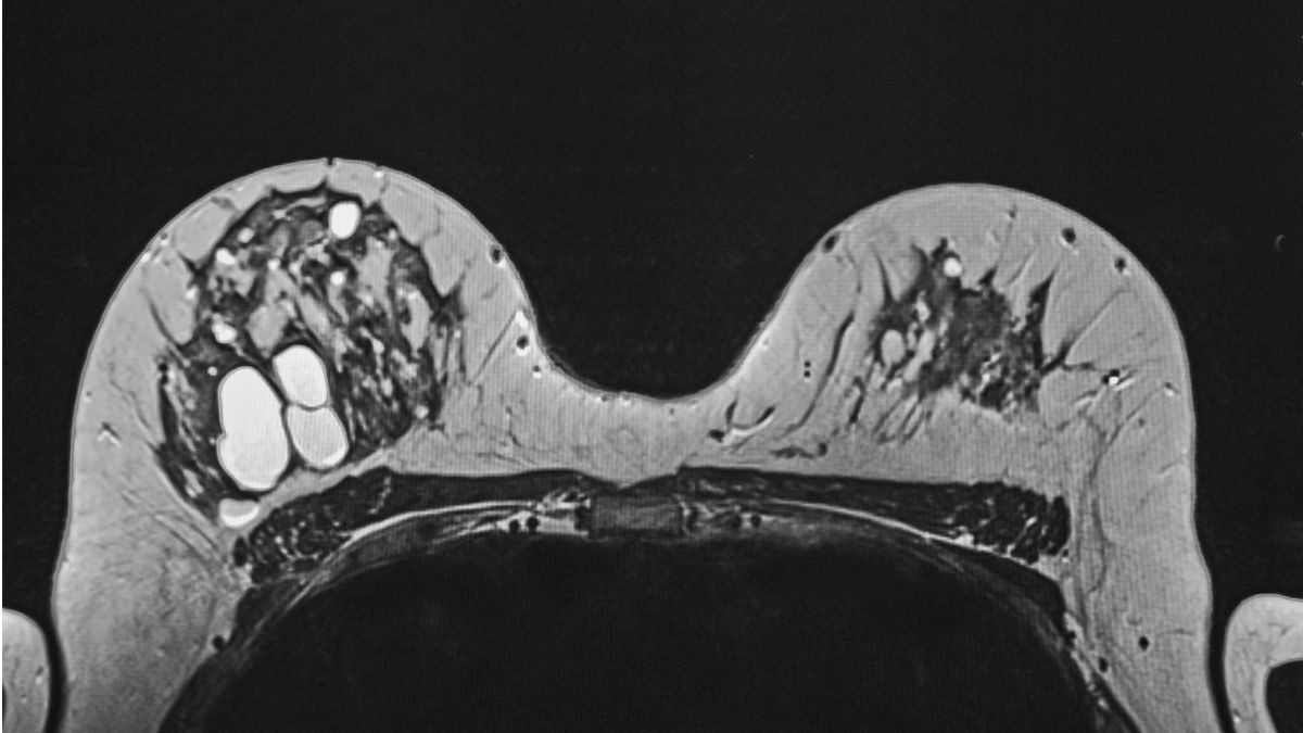 Fakta Seputar Mamografi Payudara yang Mesti Anda Ketahui