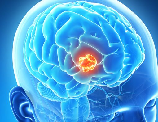 Waspadai 7 Gejala Kanker Otak seperti Dialami Agung Hercules