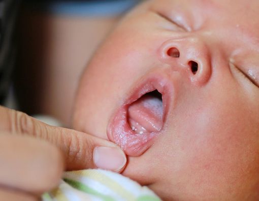 Masalah Kesehatan Mulut yang Sering Terjadi pada Bayi