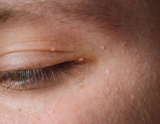 Ternyata, Ini 6 Penyebab Munculnya Milia