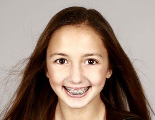 Kapan Anak Boleh Mulai Pasang Behel Gigi?