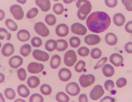 Penyebab dan Cara Mengatasi Eosinofil Rendah