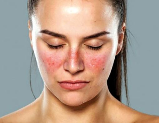 Penyebab Penyakit Lupus Belum Diketahui, Ini 5 Pemicunya