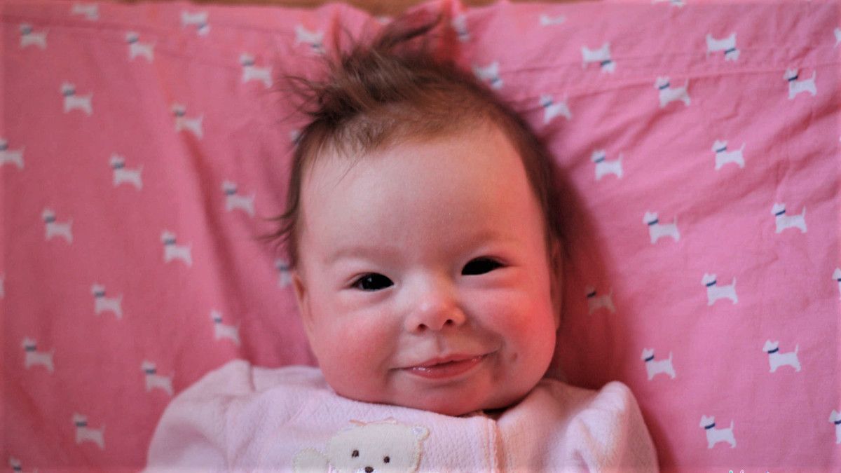 Benarkah Sindrom Williams Penyakit Keturunan?