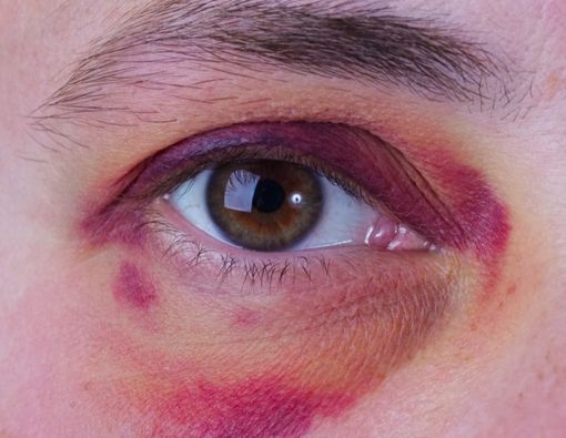 6 Cara Efektif Menghilangkan Memar di Mata