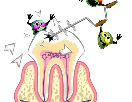 4 Hal Utama yang Berperan pada Terjadinya Gigi Berlubang