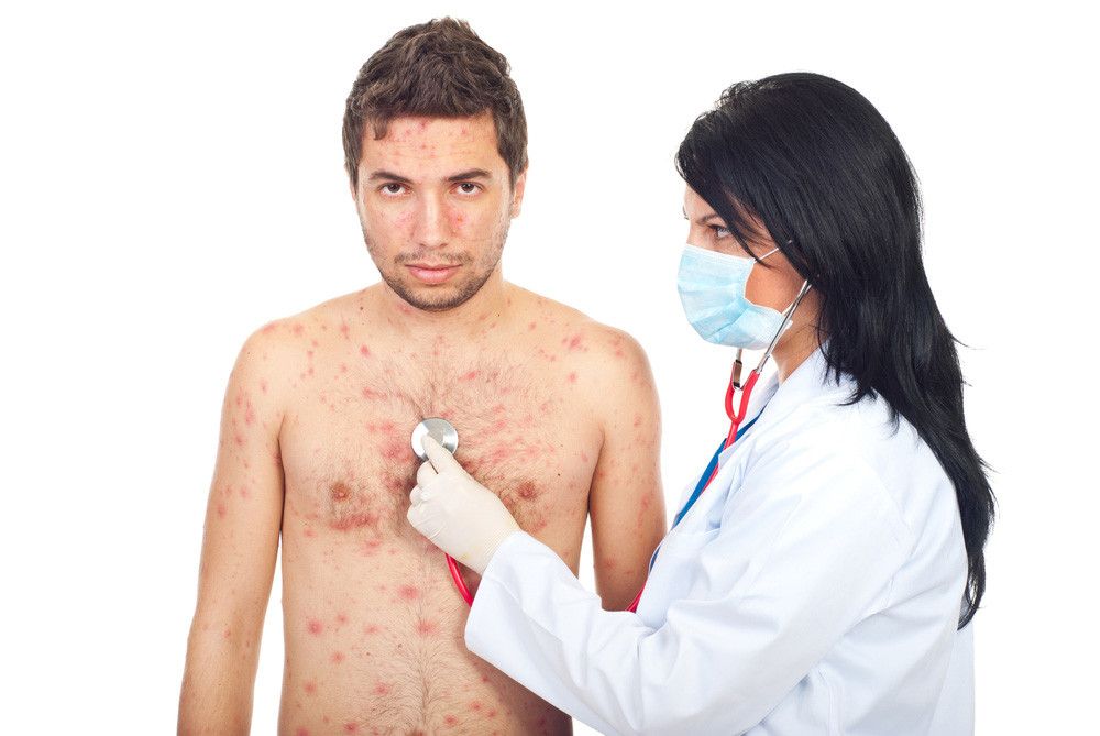 Bisakah Cacar Air Terjadi Lebih dari Sekali?