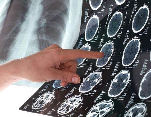 Sakit Kepala Biasa atau Akibat Tumor?