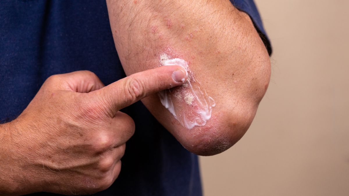 Losion Calamine