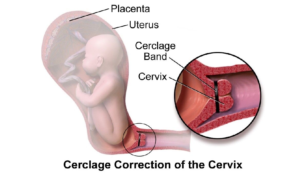 Mengenal Cervical Cerclage yang Dilakukan Pada Ibu Hamil