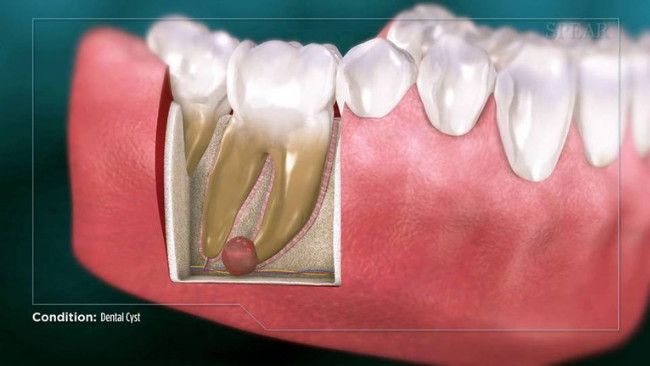 Mengenal Bahaya di Balik Kista Gigi