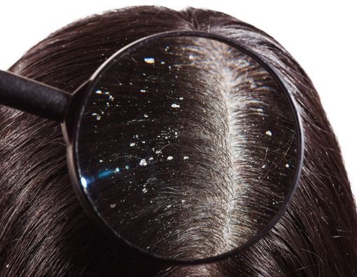 Atasi Ketombe di Kepala dengan Cara Tepat Ini