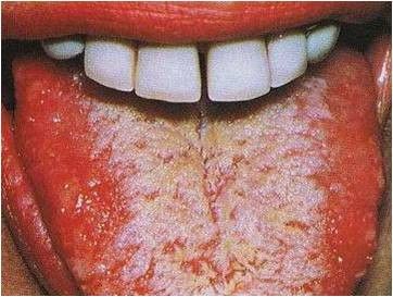 Gejala Awal HIV dalam Mulut