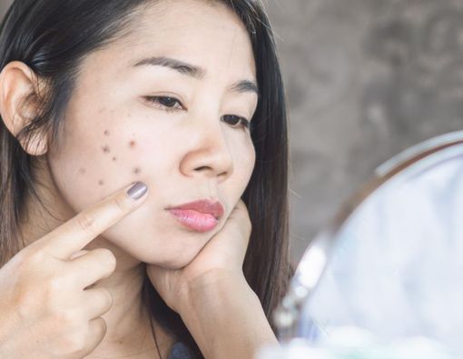 12 Penyebab Jerawat di Pipi yang Perlu Kamu Ketahui