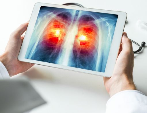 Mengenal Prosedur Krioablasi untuk Pengobatan Kanker