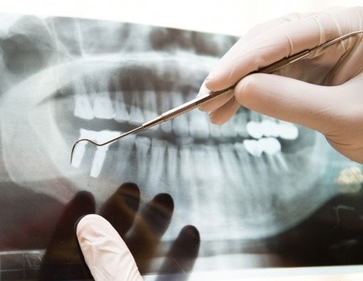 Ketika Gigi Perlu di Rontgen