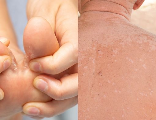 Pakai Bawang Putih untuk Atasi Kutu Air dan Panu, Efektifkah?